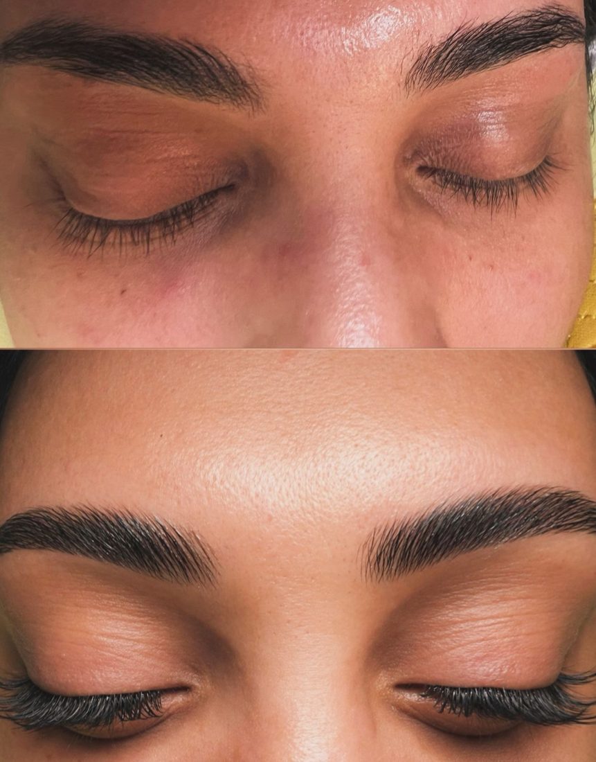 Brow lift profil avant après