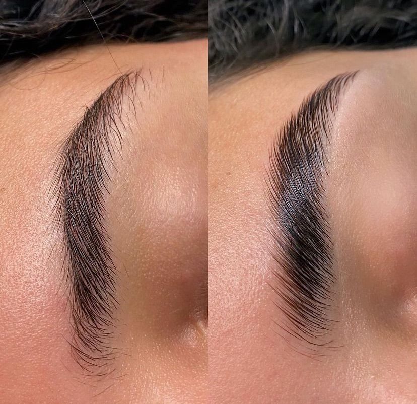 Brow lift résultat