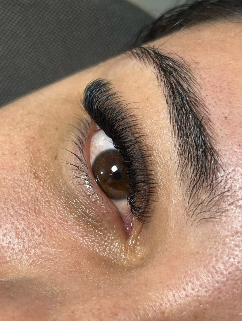 Brow lift avant après